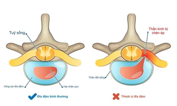 Các dạng bệnh cơ xương khớp phổ biến